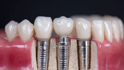 5 Key Benefits of Choosing Veterinary Dental Implants for Your Practice